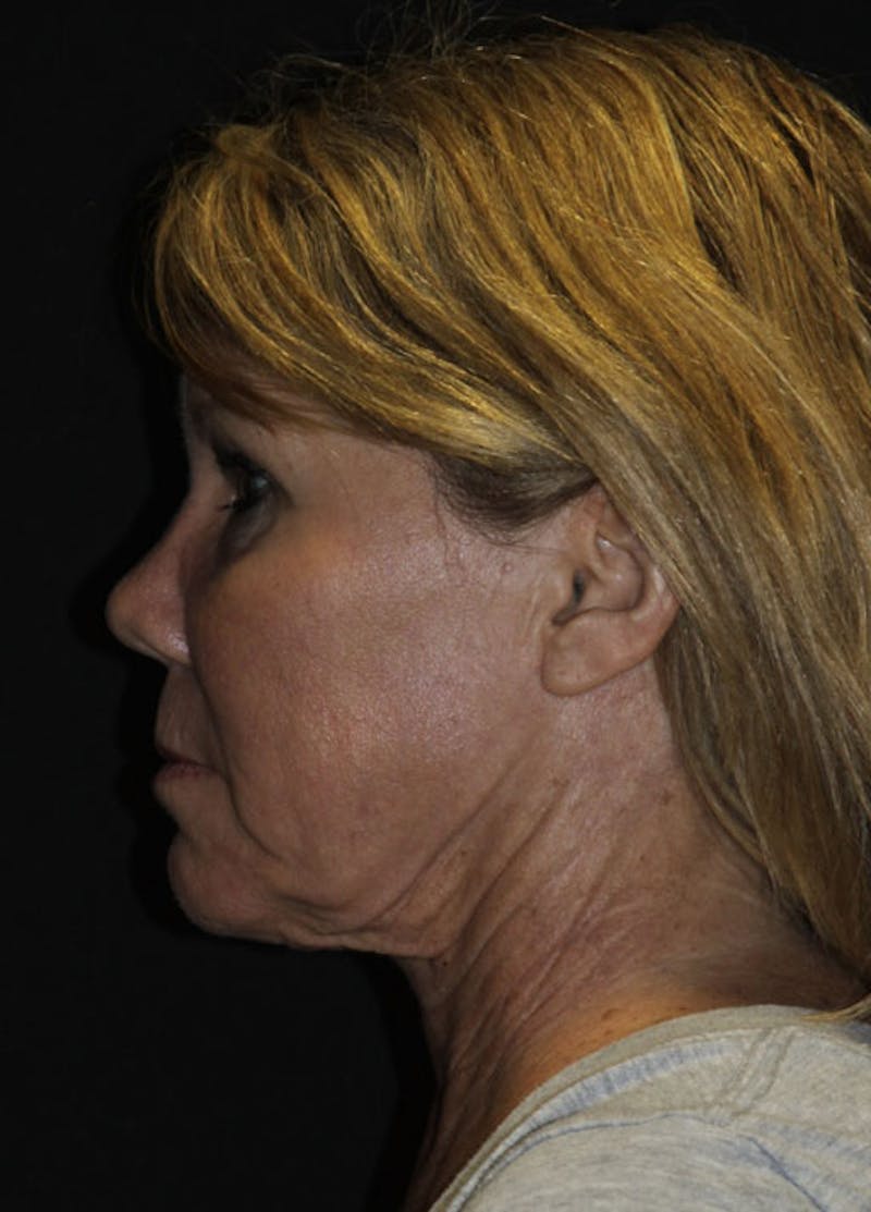 Facelift & Necklift Before & After Gallery - Patient 133023962 - Image 5