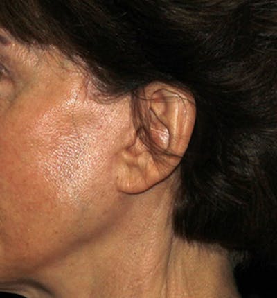 Facelift Scar Before & After Gallery - Patient 133023964 - Image 2