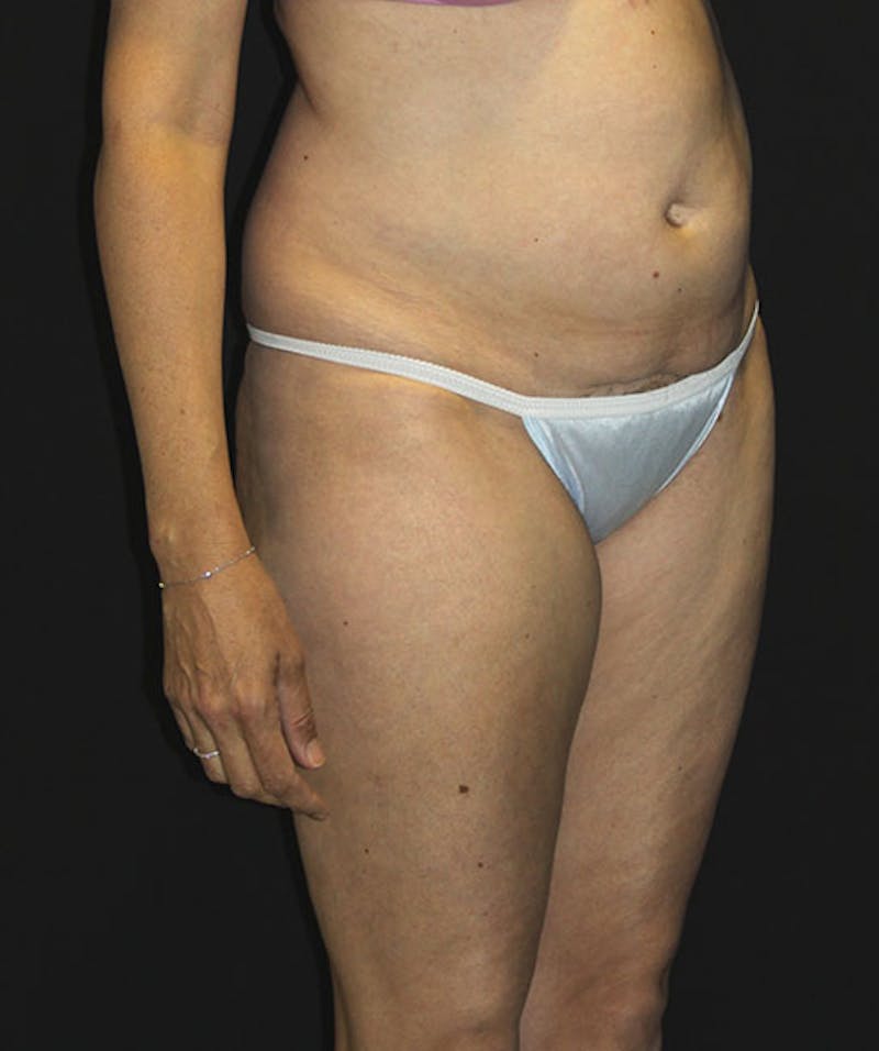 Tummy Tuck Before & After Gallery - Patient 133023963 - Image 9