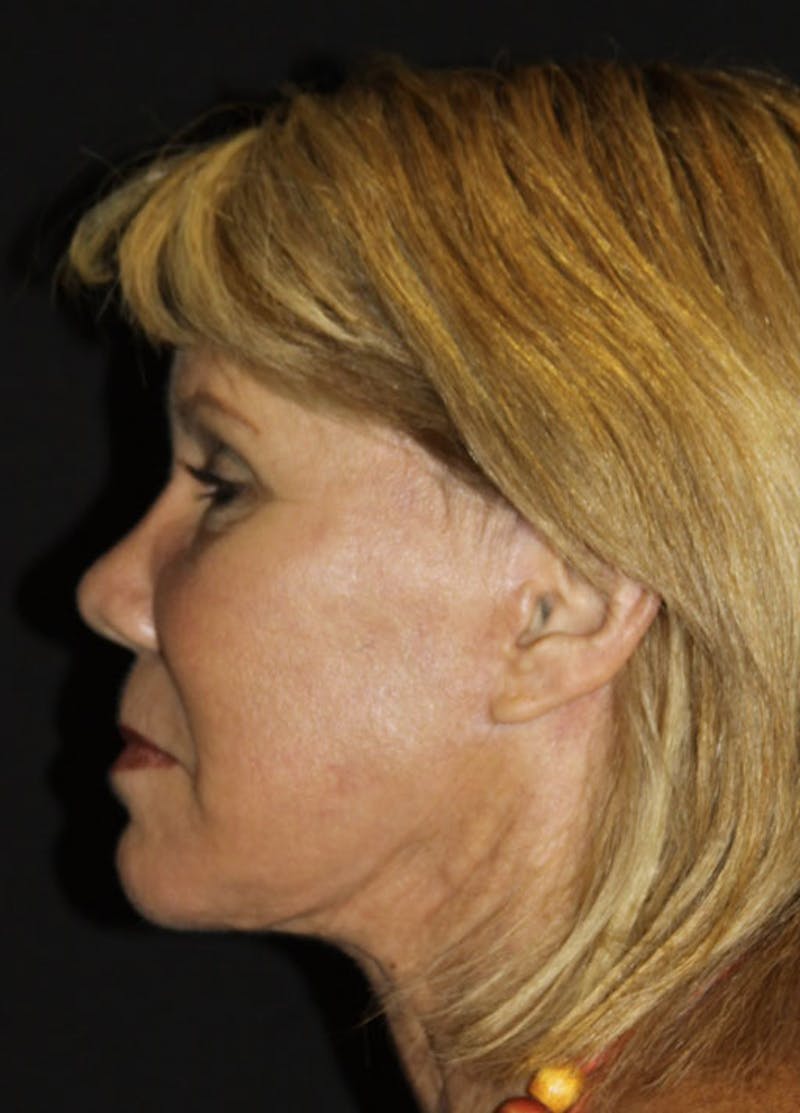 Facelift & Necklift Before & After Gallery - Patient 133023962 - Image 6