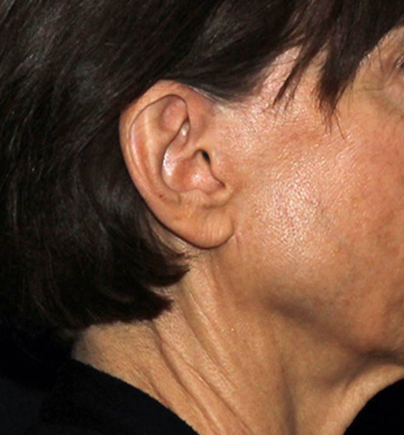 Facelift Scar Before & After Gallery - Patient 133023964 - Image 3