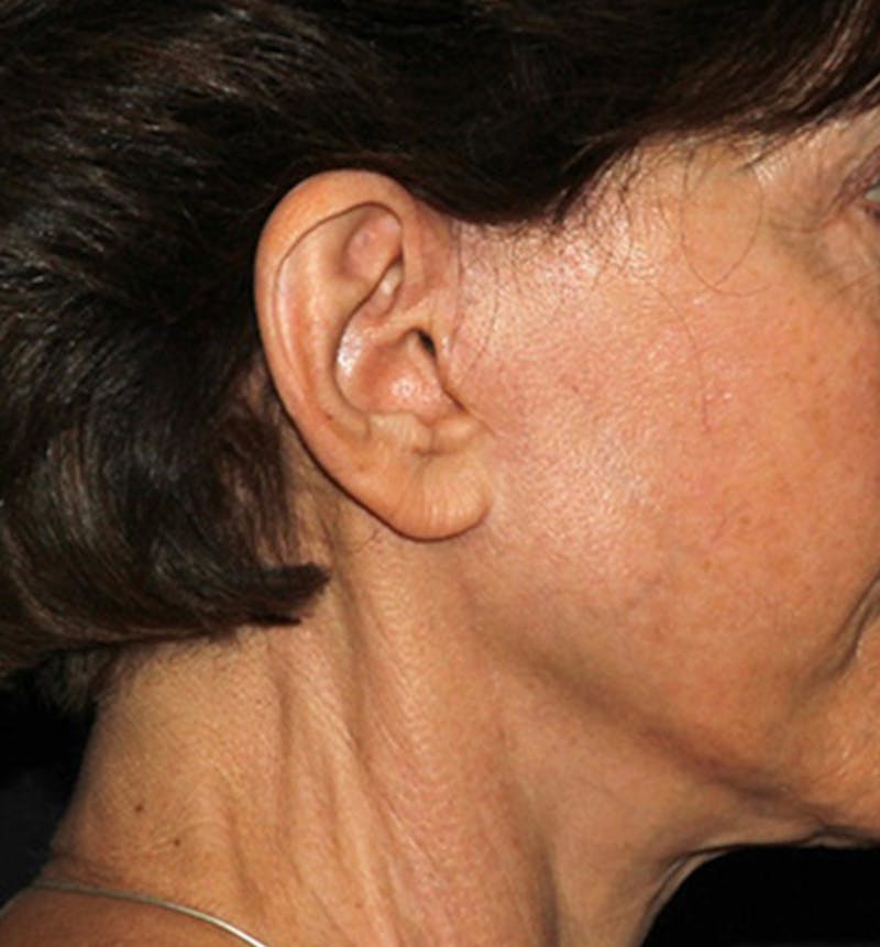 Facelift Scar Before & After Gallery - Patient 133023964 - Image 4