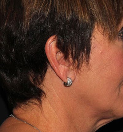 Facelift Scar Before & After Gallery - Patient 133023965 - Image 1