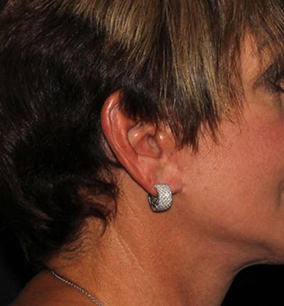 Facelift Scar Before & After Gallery - Patient 133023965 - Image 2