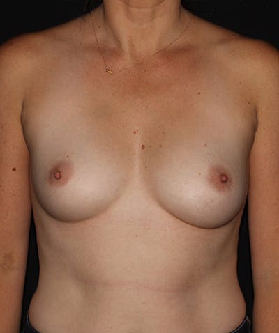 Breast Augmentation Before & After Gallery - Patient 133023980 - Image 1