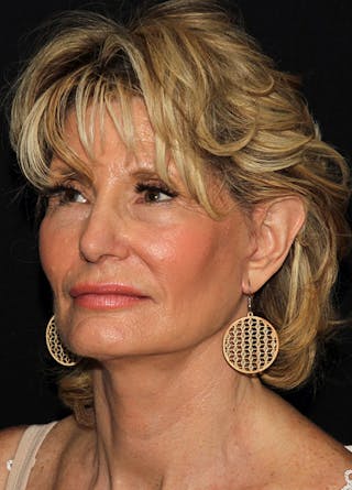 Fat Grafting Before & After Gallery - Patient 133023969 - Image 4