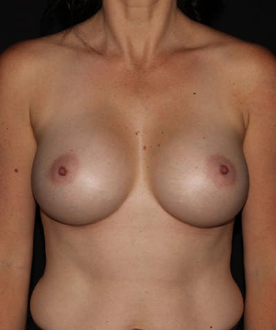 Breast Augmentation Before & After Gallery - Patient 133023980 - Image 2