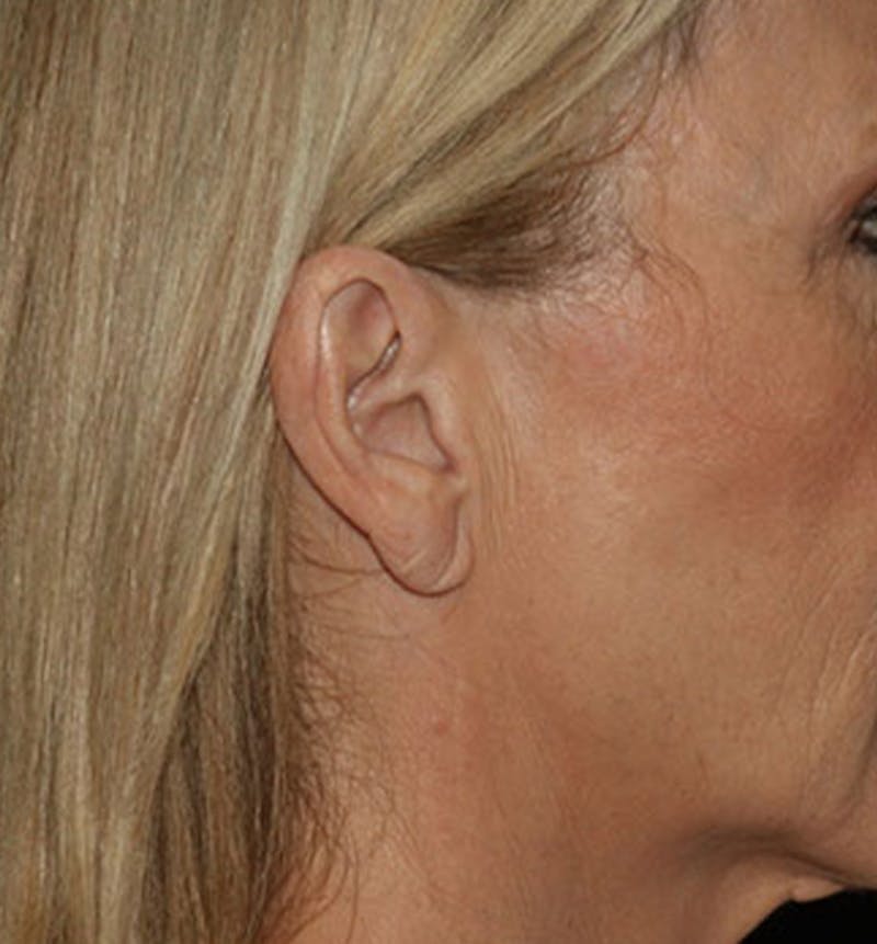 Facelift Scar Before & After Gallery - Patient 133023970 - Image 1