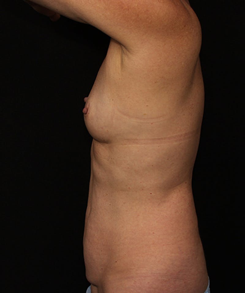 Tummy Tuck Before & After Gallery - Patient 133023977 - Image 5