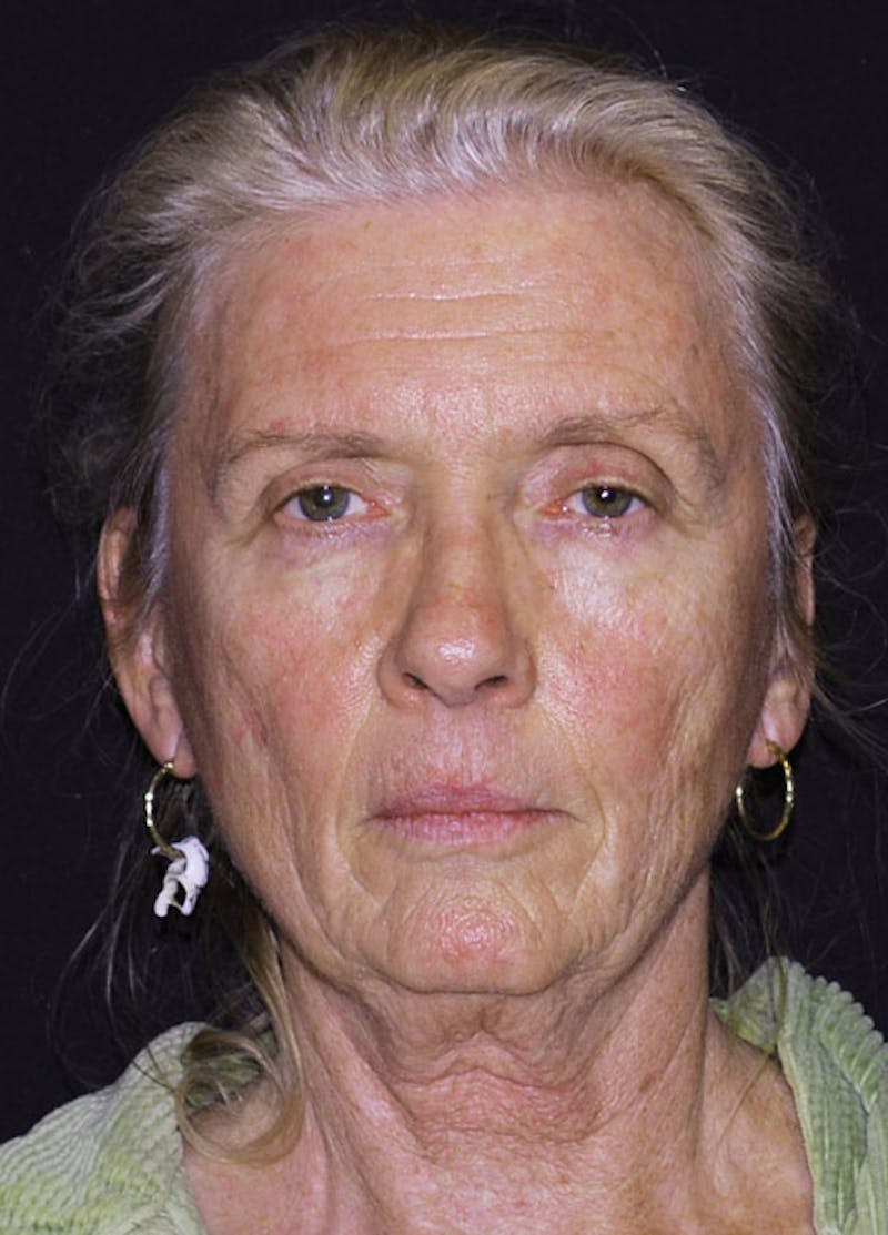 Facelift & Necklift Before & After Gallery - Patient 133023975 - Image 1