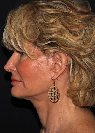 Fat Grafting Before & After Gallery - Patient 133023969 - Image 6