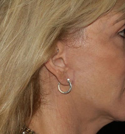 Facelift Scar Before & After Gallery - Patient 133023970 - Image 2