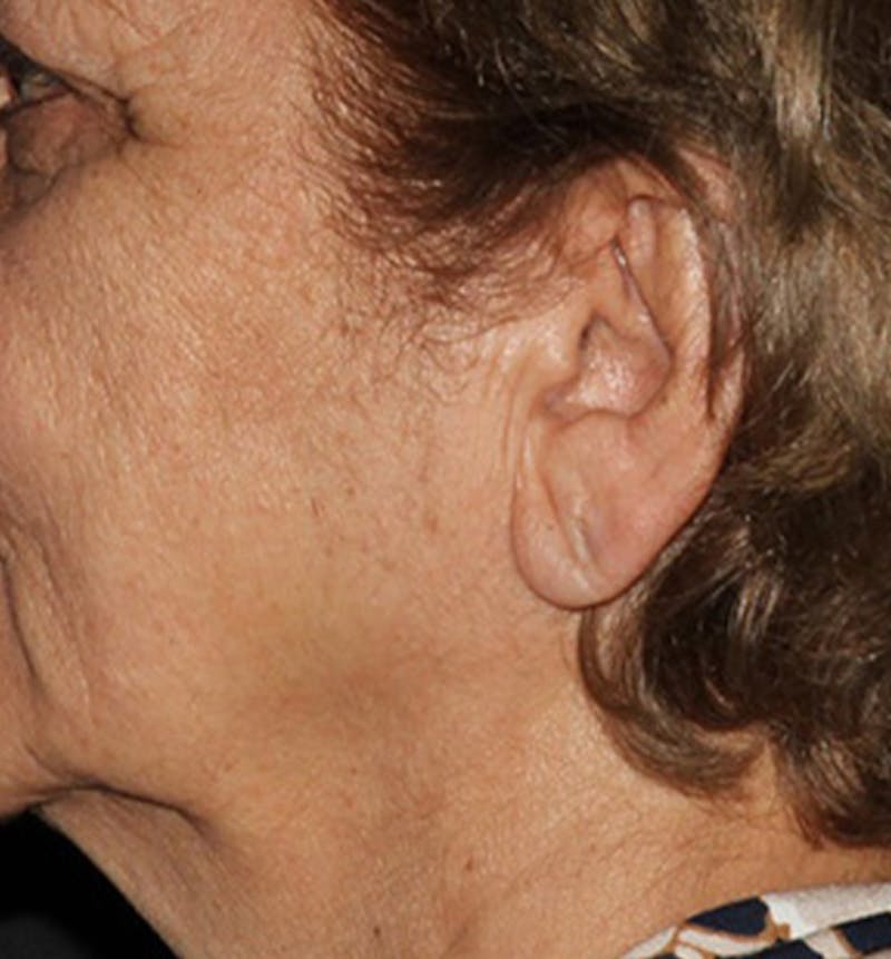 Facelift Scar Before & After Gallery - Patient 133023973 - Image 1