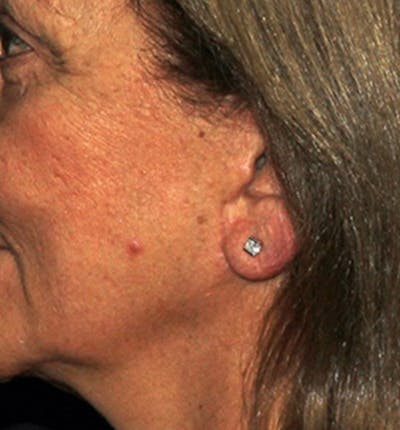 Facelift Scar Before & After Gallery - Patient 133023973 - Image 2