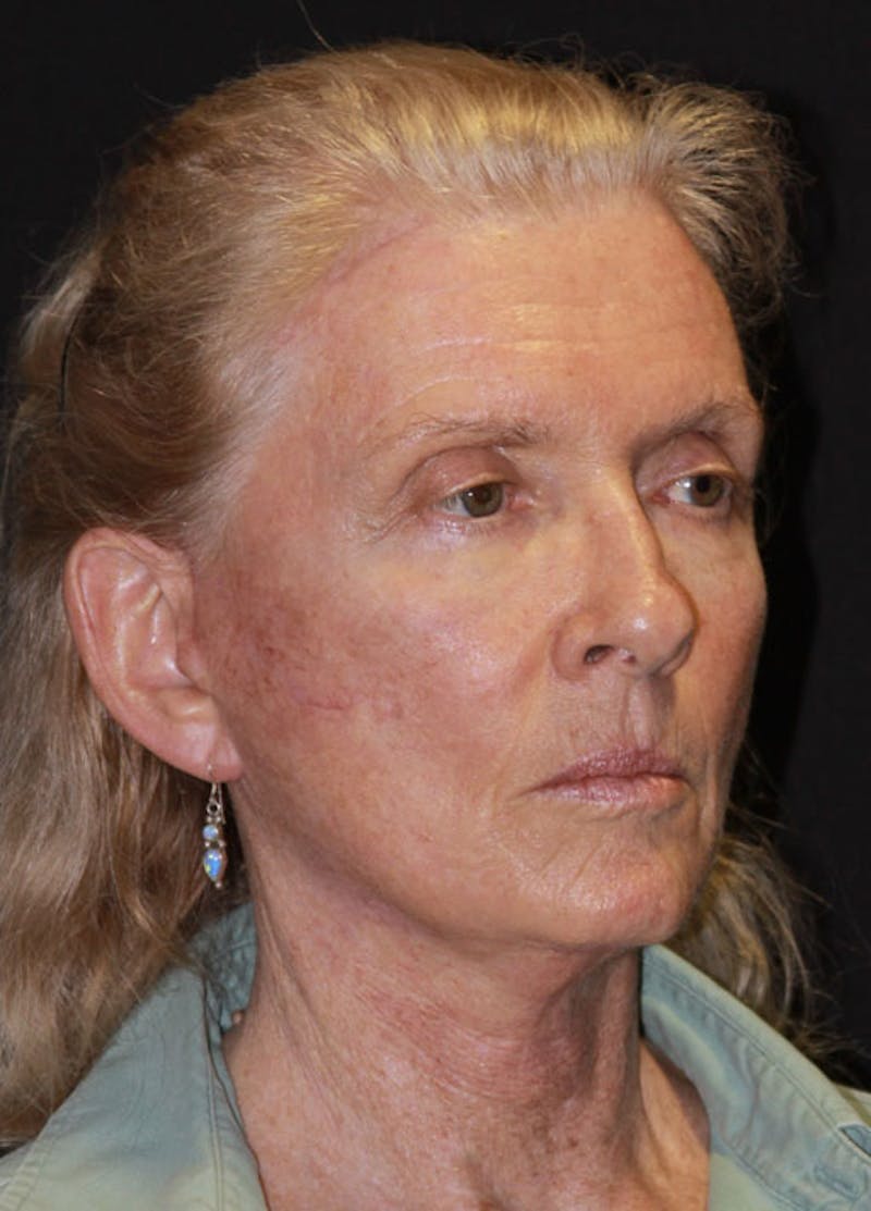Facelift & Necklift Before & After Gallery - Patient 133023975 - Image 4