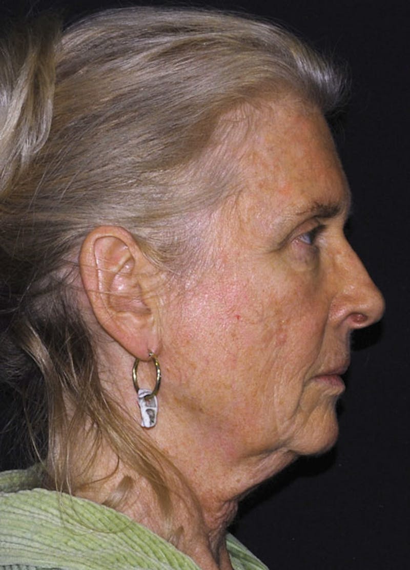 Facelift & Necklift Before & After Gallery - Patient 133023975 - Image 5