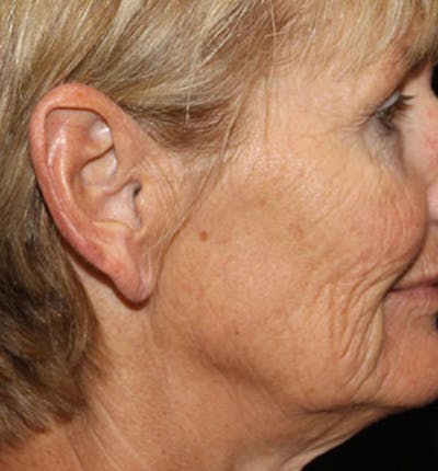 Facelift Scar Before & After Gallery - Patient 133023976 - Image 1