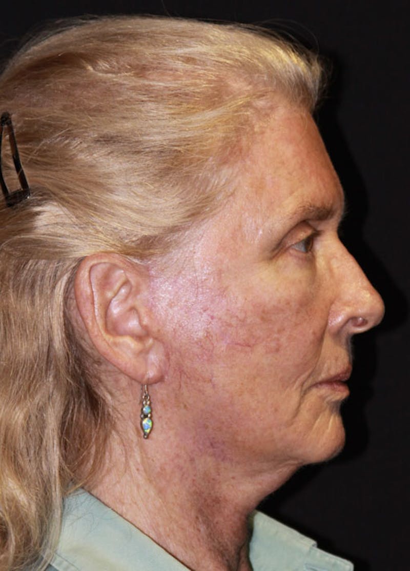 Facelift & Necklift Before & After Gallery - Patient 133023975 - Image 6