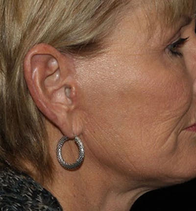 Facelift Scar Before & After Gallery - Patient 133023976 - Image 2