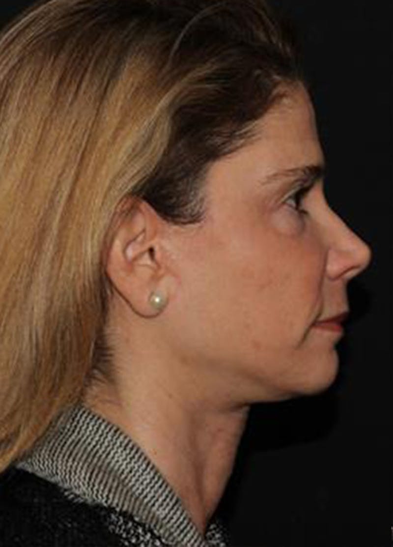 Fat Grafting Before & After Gallery - Patient 133023983 - Image 6