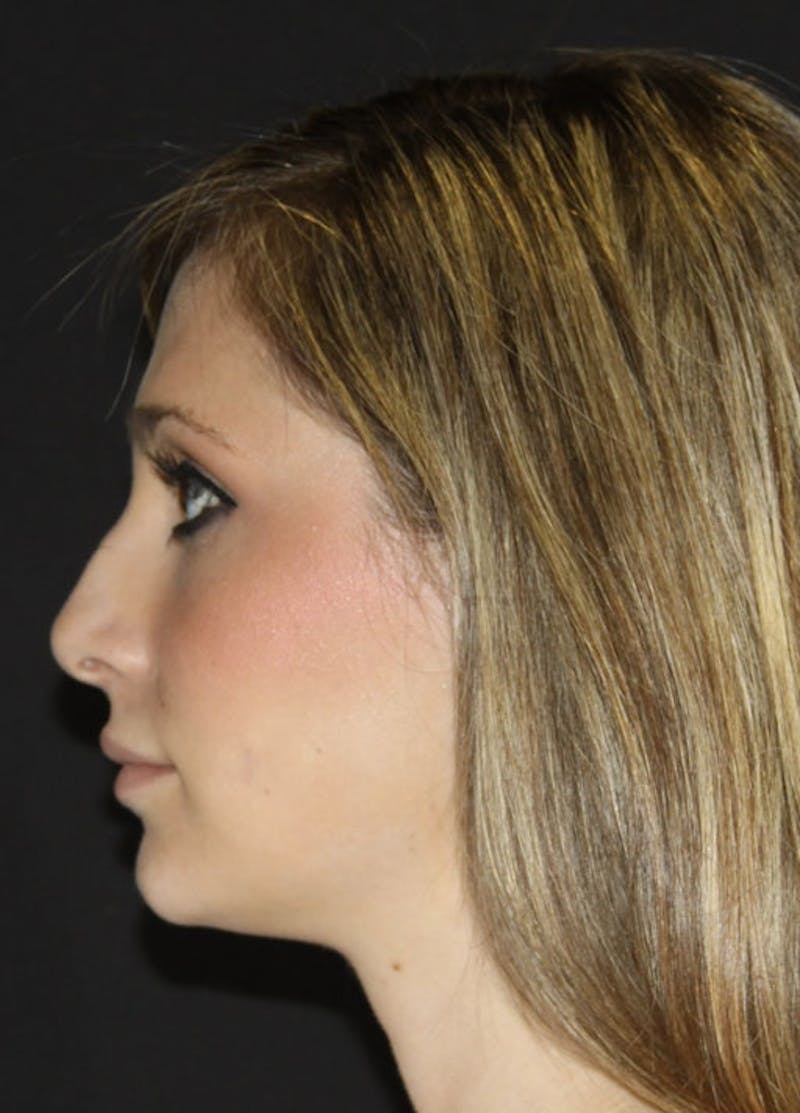 Neck Liposuction Before & After Gallery - Patient 133023986 - Image 3