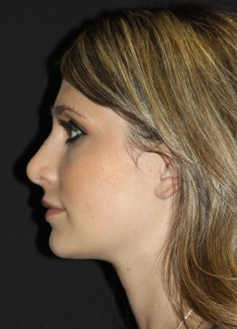 Neck Liposuction Before & After Gallery - Patient 133023986 - Image 4
