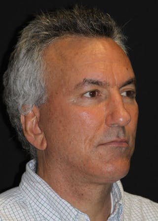 Facelift & Necklift Before & After Gallery - Patient 133023991 - Image 4