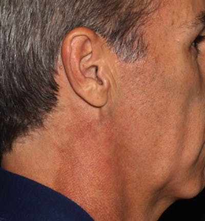 Facelift Scar Before & After Gallery - Patient 133023989 - Image 1