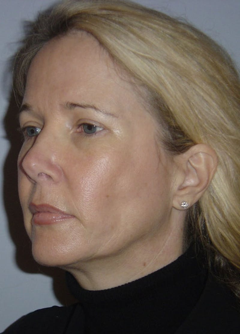 Fat Grafting Before & After Gallery - Patient 133023990 - Image 3