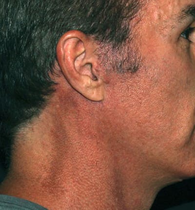 Facelift Scar Before & After Gallery - Patient 133023989 - Image 2