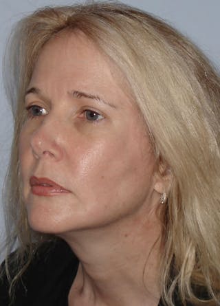 Fat Grafting Before & After Gallery - Patient 133023990 - Image 4