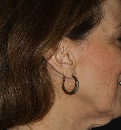Facelift Scar Before & After Gallery - Patient 133023992 - Image 1
