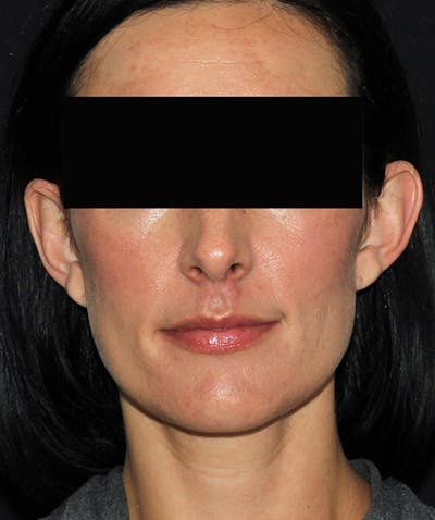 Otoplasty Before & After Gallery - Patient 133024001 - Image 1
