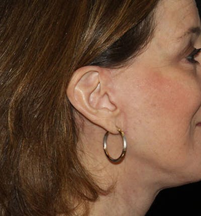Facelift Scar Before & After Gallery - Patient 133023992 - Image 2