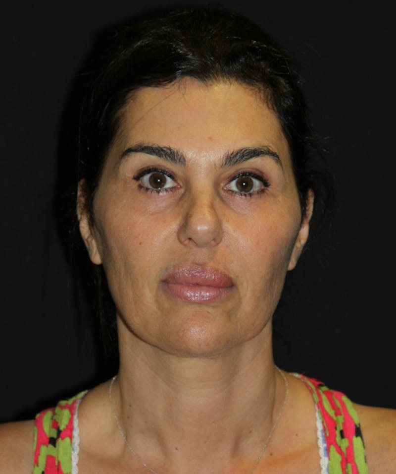 Facelift & Necklift Before & After Gallery - Patient 133024005 - Image 1