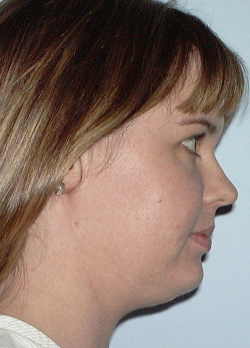 Neck Liposuction Before & After Gallery - Patient 133023994 - Image 3