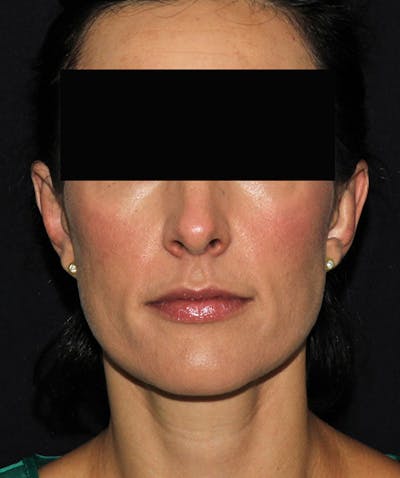 Otoplasty Before & After Gallery - Patient 133024001 - Image 2