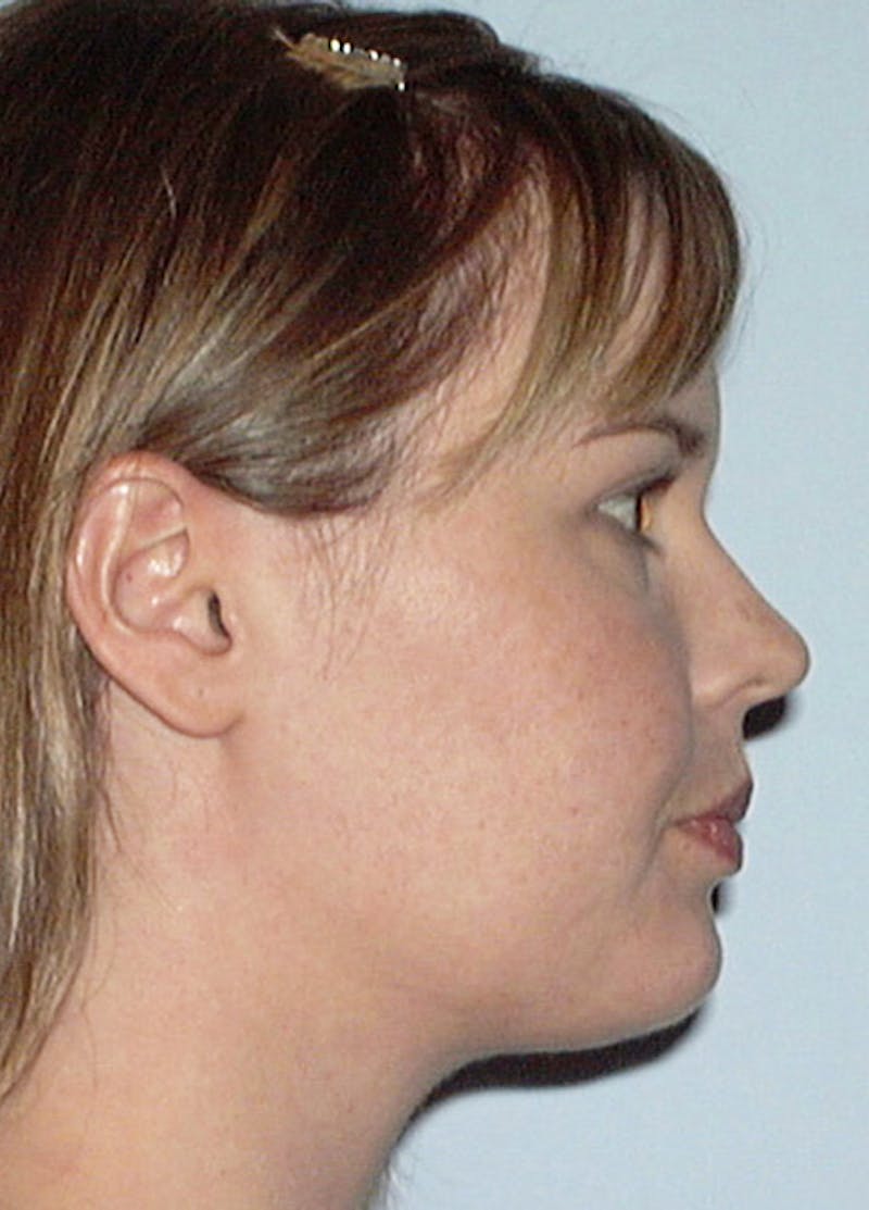 Neck Liposuction Before & After Gallery - Patient 133023994 - Image 4