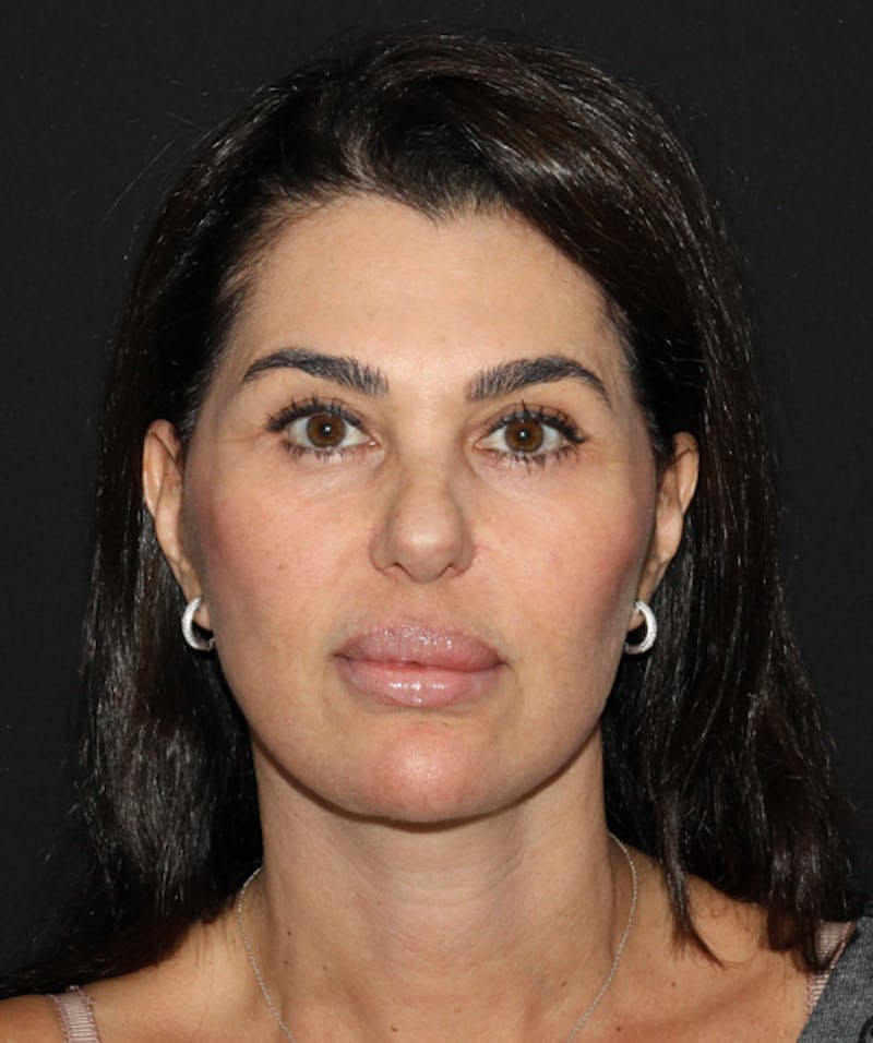 Facelift & Necklift Before & After Gallery - Patient 133024005 - Image 2