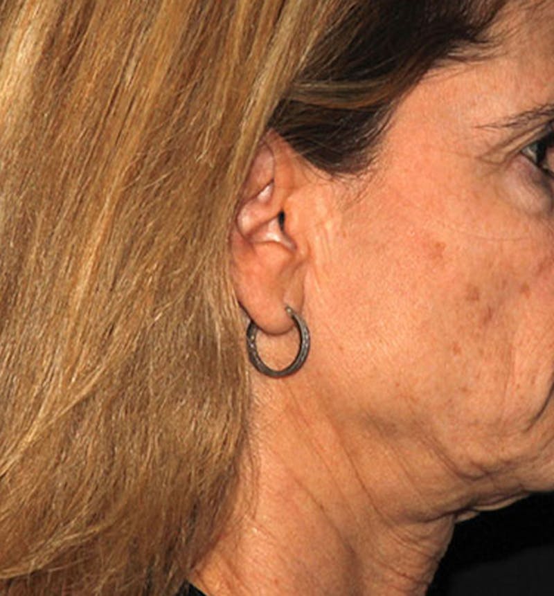 Facelift Scar Before & After Gallery - Patient 133023998 - Image 1