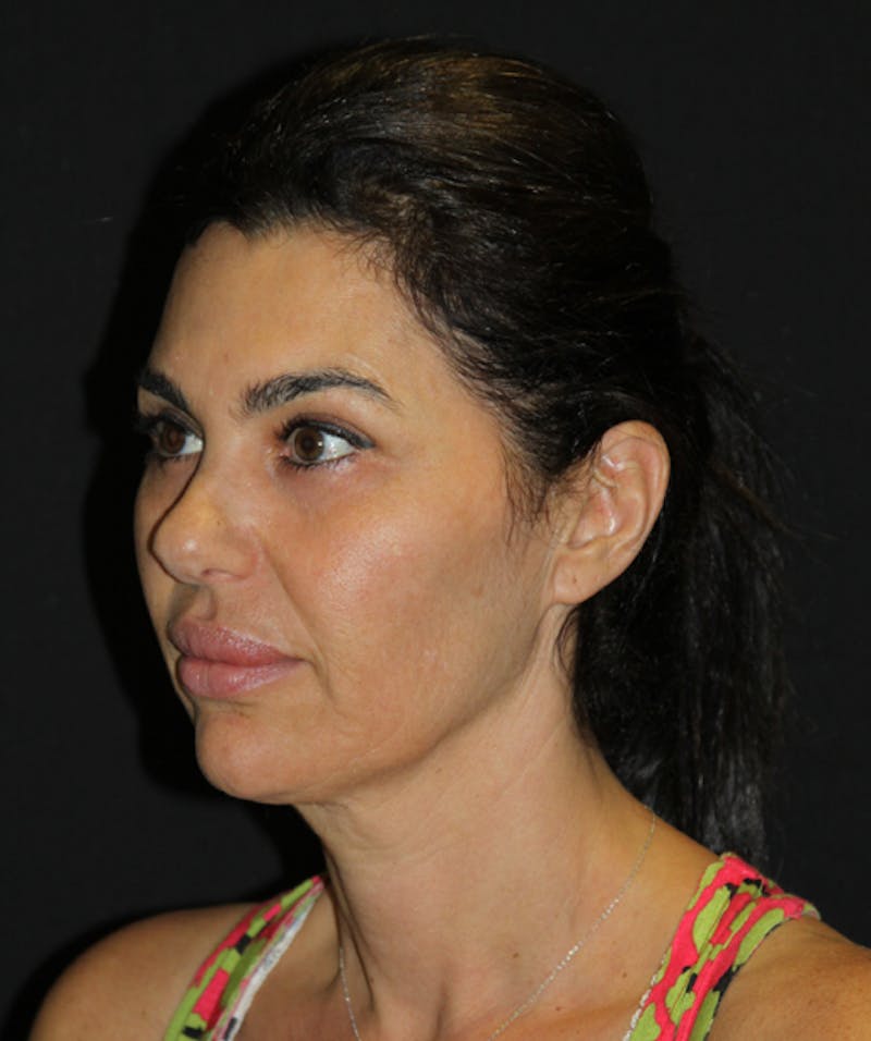 Facelift & Necklift Before & After Gallery - Patient 133024005 - Image 3