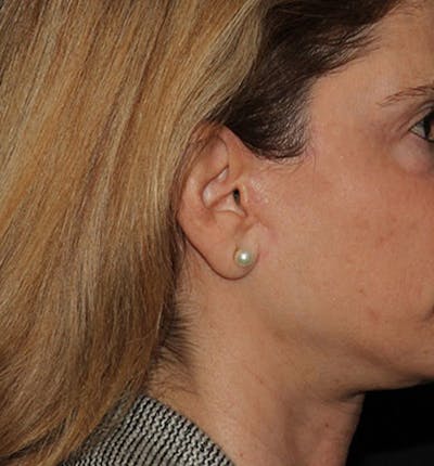 Facelift Scar Before & After Gallery - Patient 133023998 - Image 2