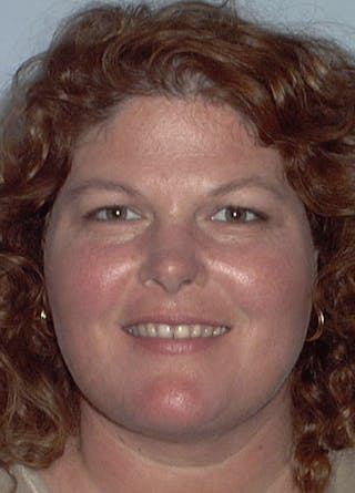 Neck Liposuction Before & After Gallery - Patient 133024000 - Image 2
