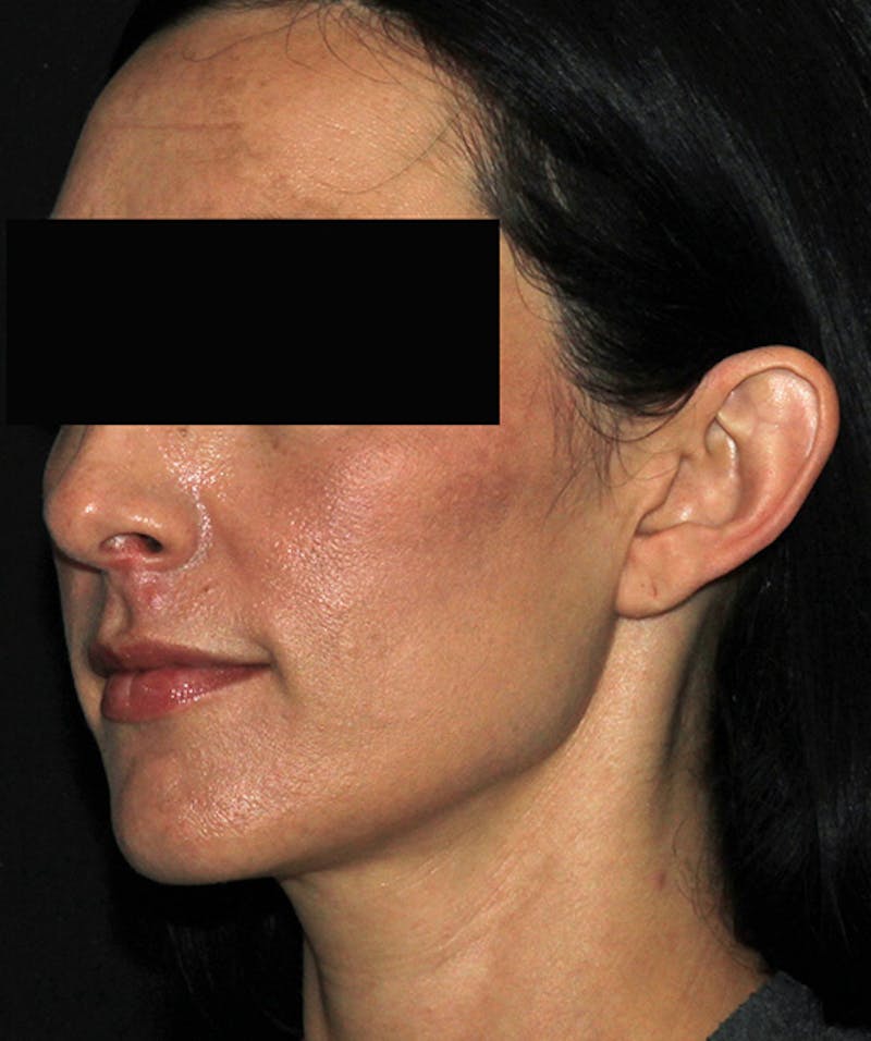 Otoplasty Before & After Gallery - Patient 133024001 - Image 5
