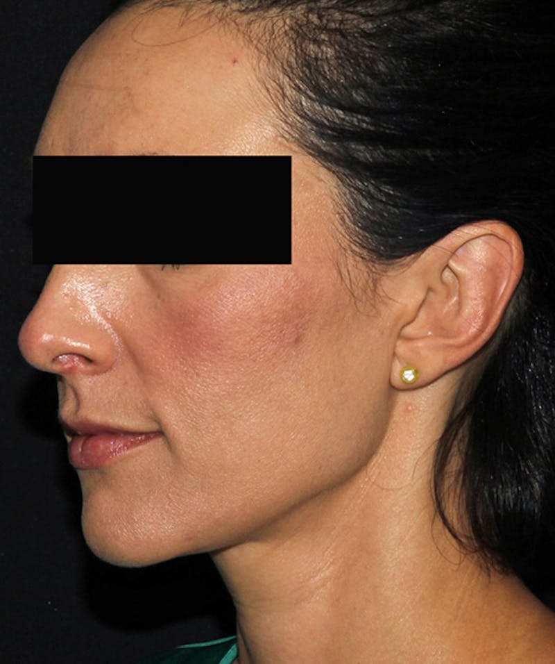 Otoplasty Before & After Gallery - Patient 133024001 - Image 6