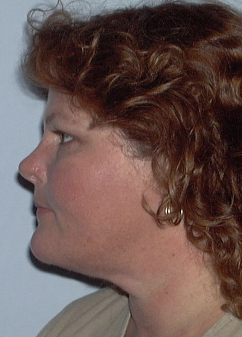 Neck Liposuction Before & After Gallery - Patient 133024000 - Image 4