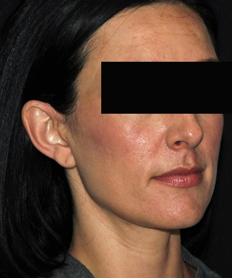 Otoplasty Before & After Gallery - Patient 133024001 - Image 7