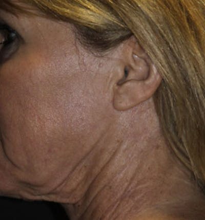 Facelift Scar Before & After Gallery - Patient 133024002 - Image 1