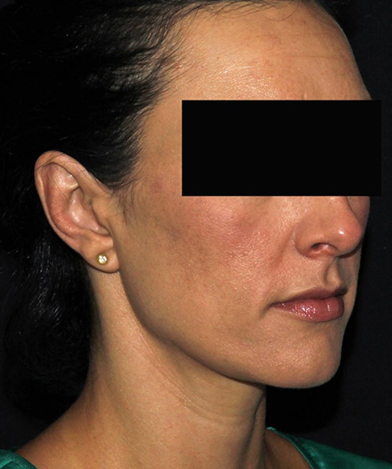 Otoplasty Before & After Gallery - Patient 133024001 - Image 8