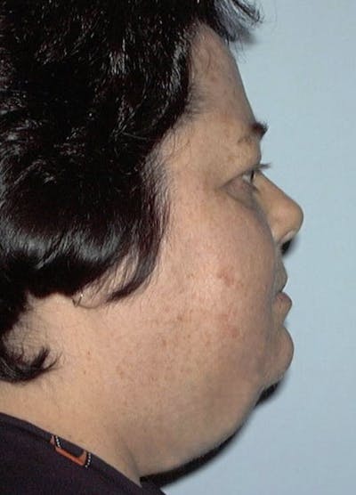 Neck Liposuction Before & After Gallery - Patient 133024003 - Image 1